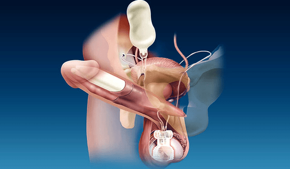 Silicone thickness filler and gel