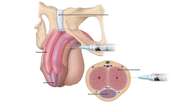 your own fat tissue injection for penis thickness