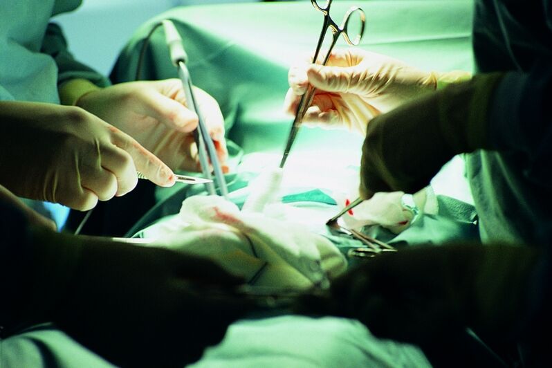 Surgical enhancement of penile thickness